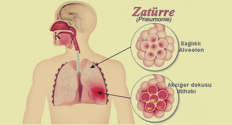 Zatürrenin tedavisi var mı?