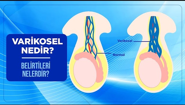 Erkeklerde varikosel belirtilerinde nelere dikkat edilmeli