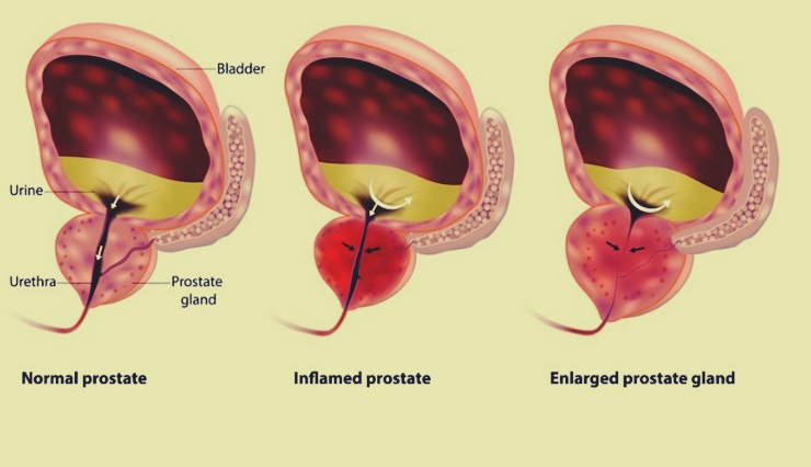 Prostat kanserinde yaşam kurtaran yöntemler nelerdir?