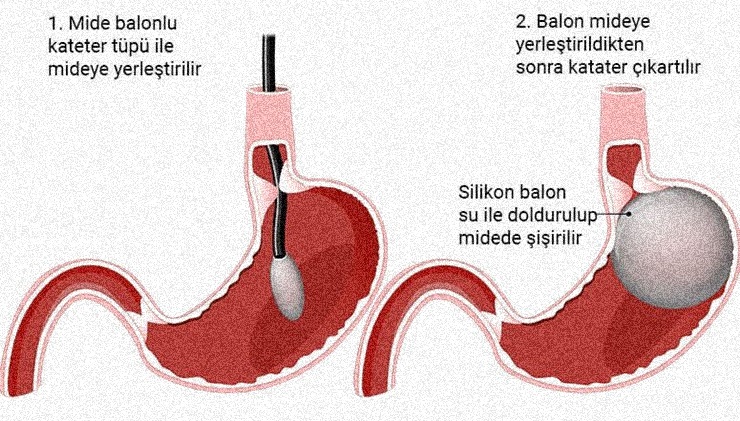 Mide balonu nedir?