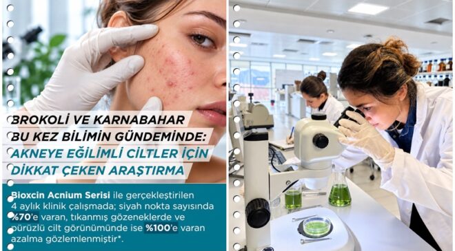 Brokoli ile karnabahar akne bakımında çığır açıyor